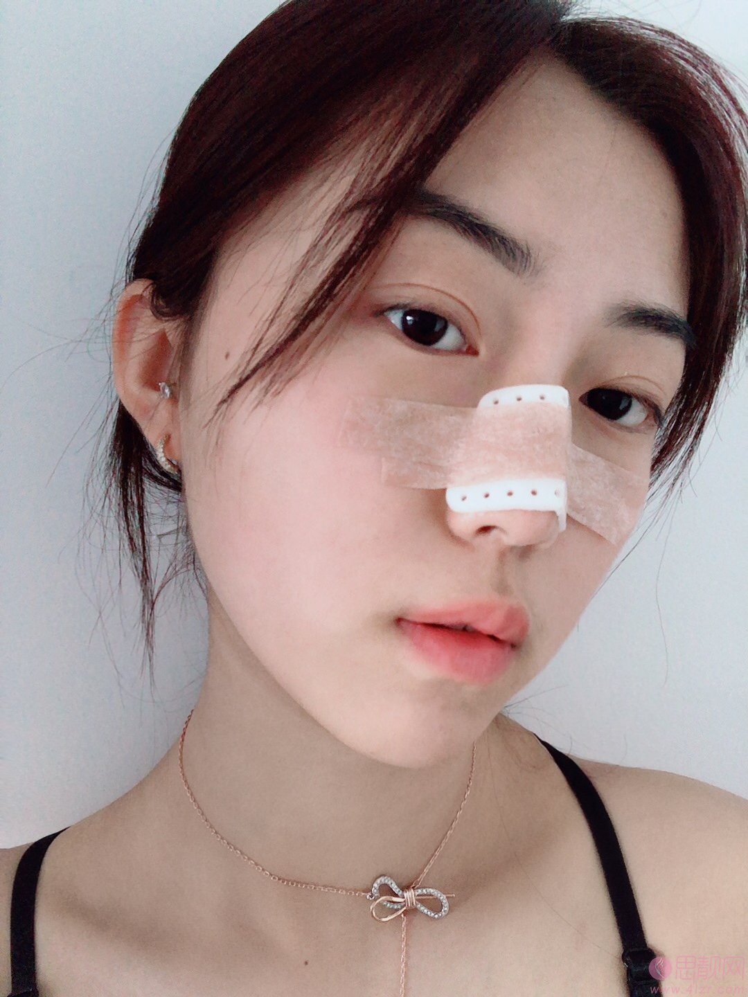 重庆艺星医疗美容医院朱家旭隆鼻好不好？2020价格表一览+隆鼻术后案例一览