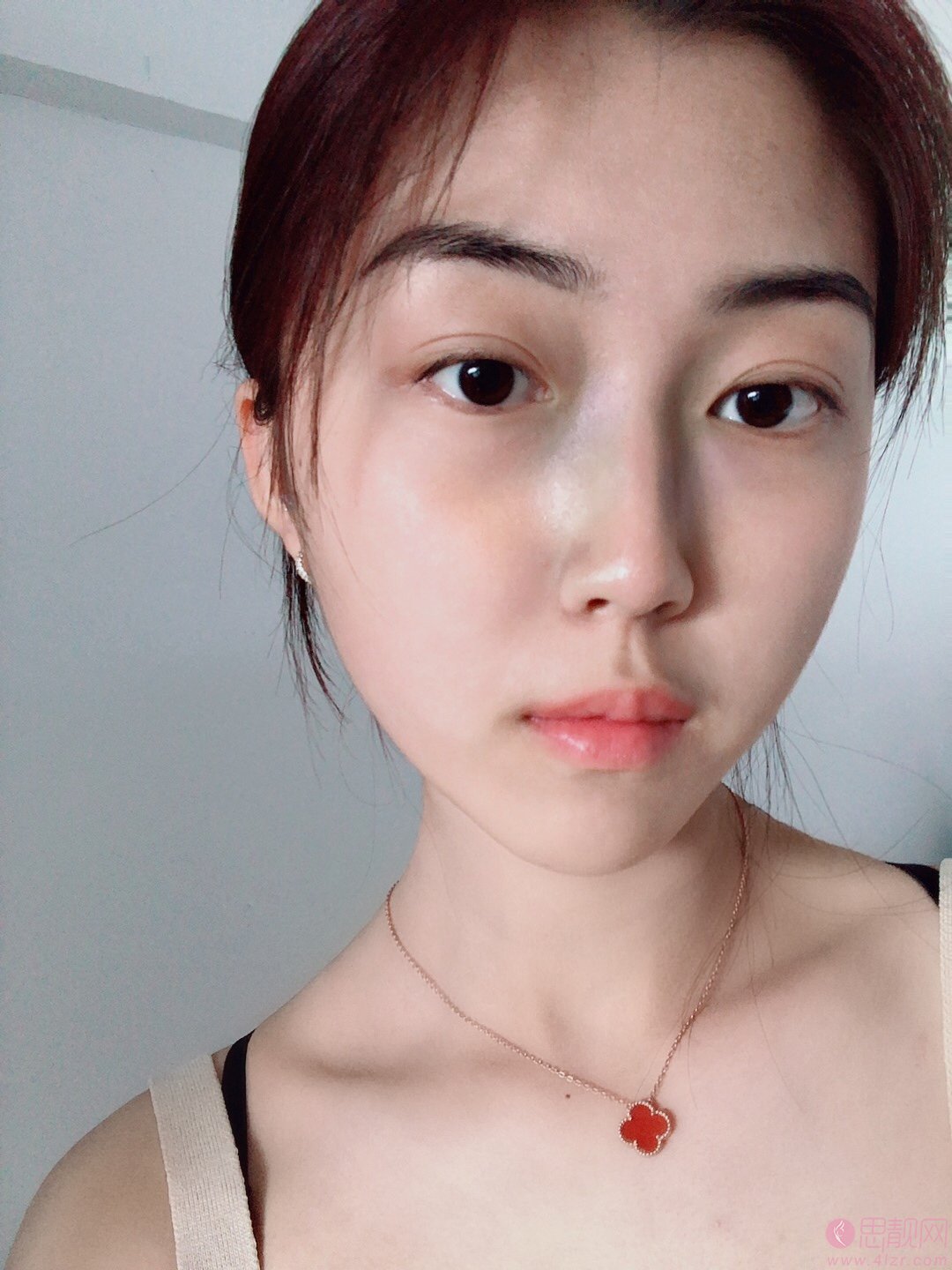 重庆艺星医疗美容医院朱家旭隆鼻好不好？2020价格表一览+隆鼻术后案例一览