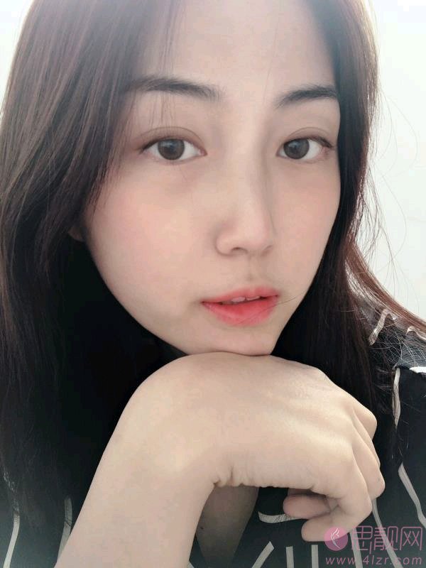 重庆艺星医疗美容医院朱家旭隆鼻好不好？2020价格表一览+隆鼻术后案例一览