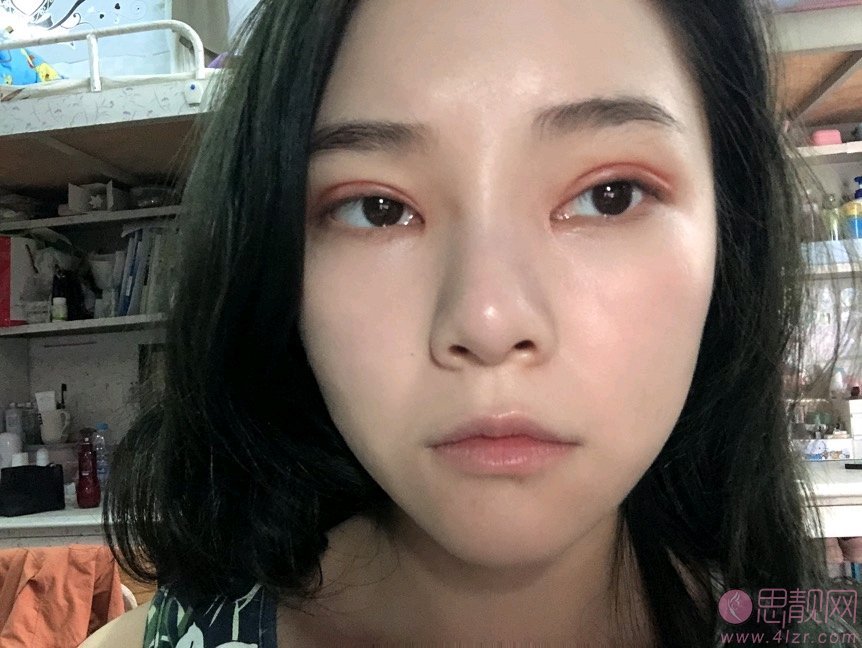 西安叶子整形美容医院朱健康做双眼皮手术好不好？2020价格表一览