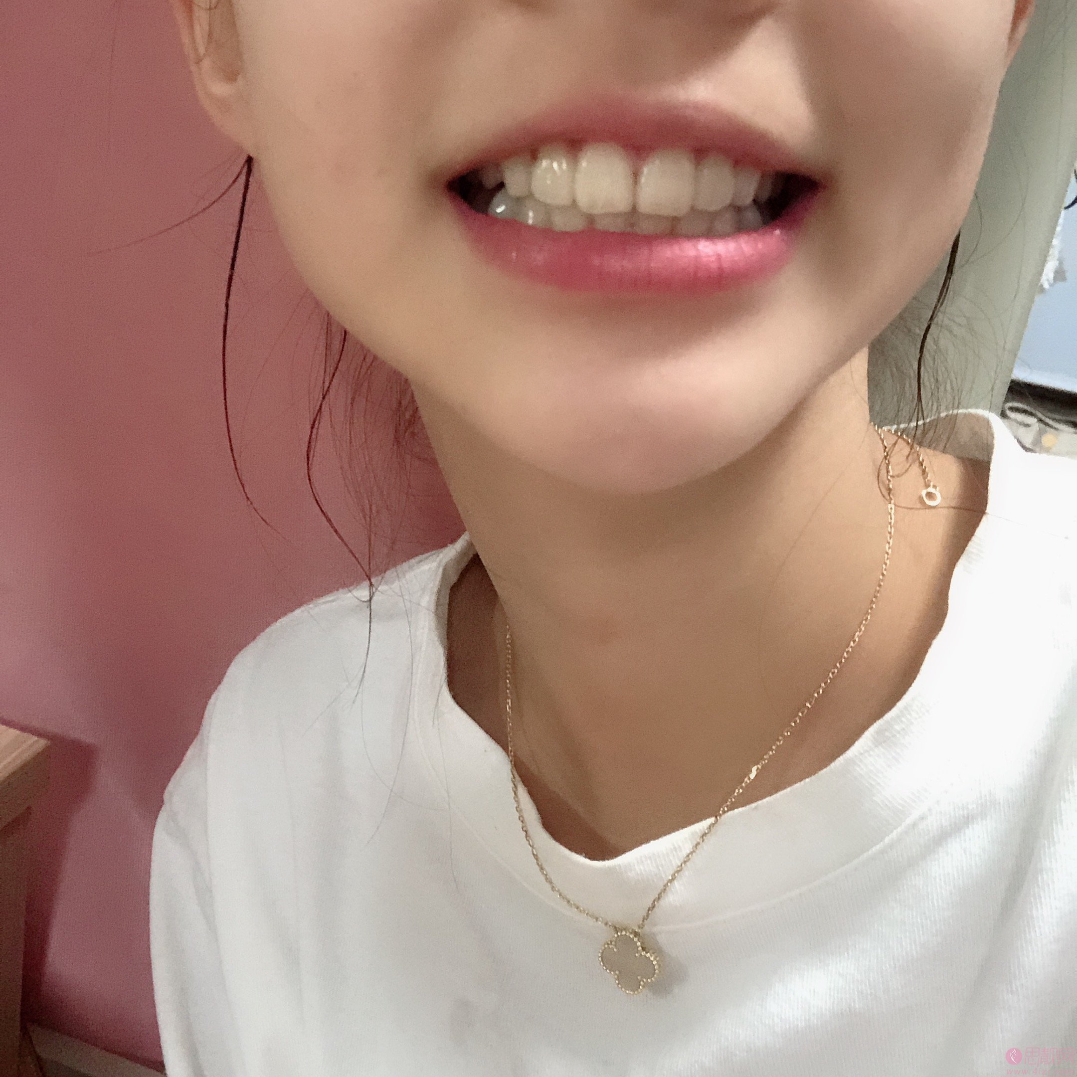 广州穗江口腔矫正修复中心美白牙齿好不好?2020价格表发布+牙齿美白真人反馈