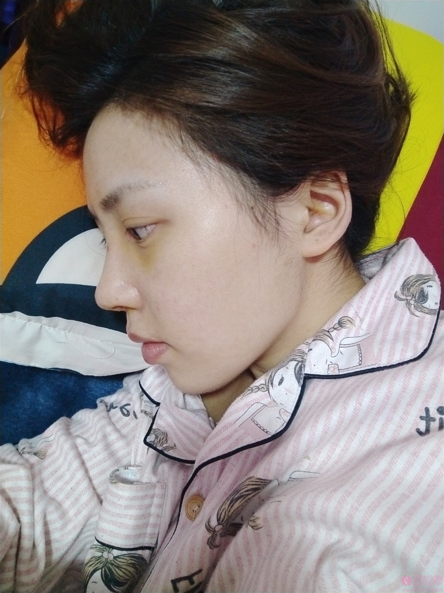 北医三院整形科李东隆鼻好不好？附隆鼻术后真人案例反馈