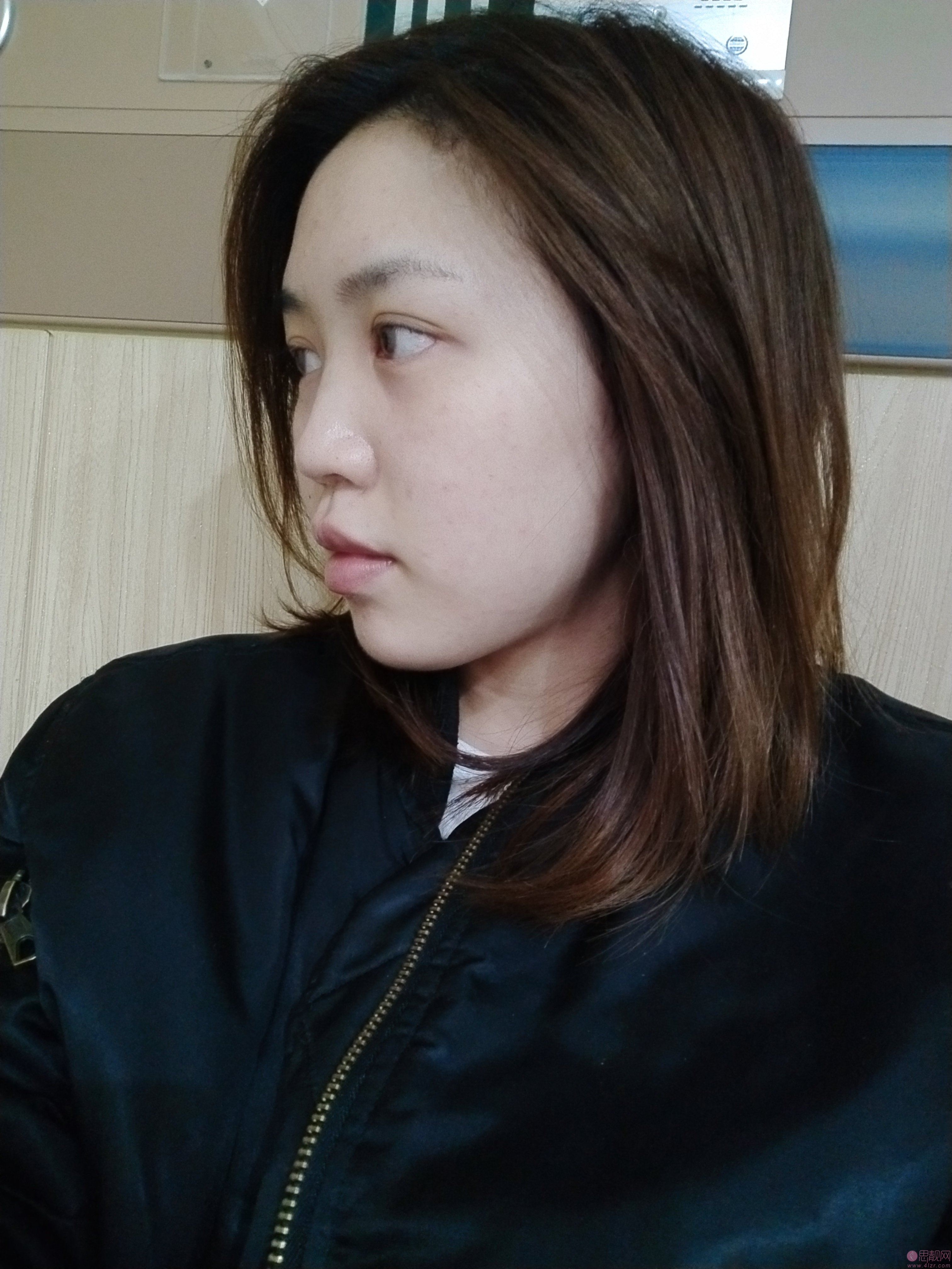 北医三院整形科李东隆鼻好不好？附隆鼻术后真人案例反馈
