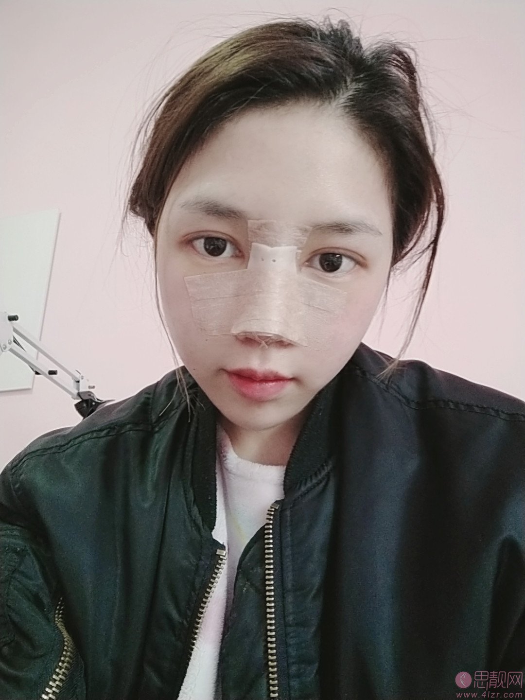 北医三院整形科李东隆鼻好不好？附隆鼻术后真人案例反馈