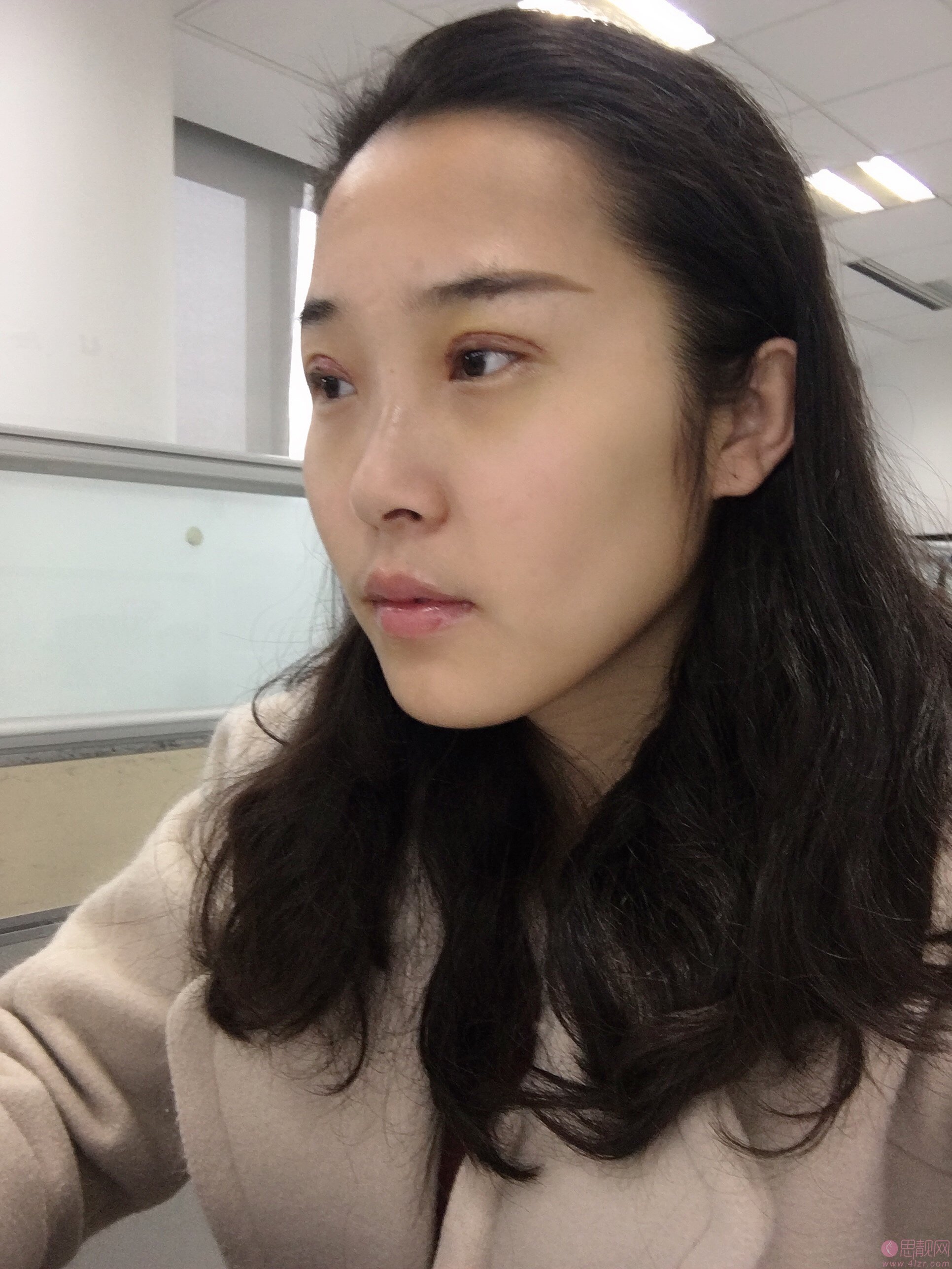 成都八大处医疗美容医院陈江庭做双眼皮好不好？2020价格表曝光