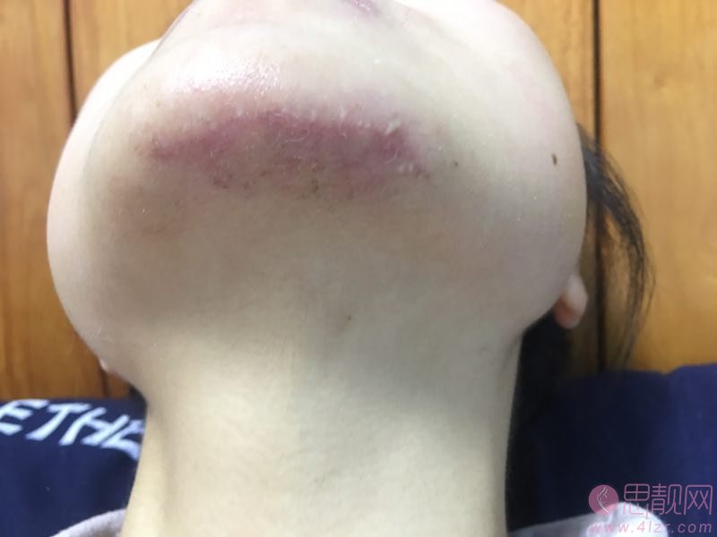 成都八大处医疗美容医院吴冬梅祛疤怎么样？附祛疤术后真人案例分享及2020价格表曝光