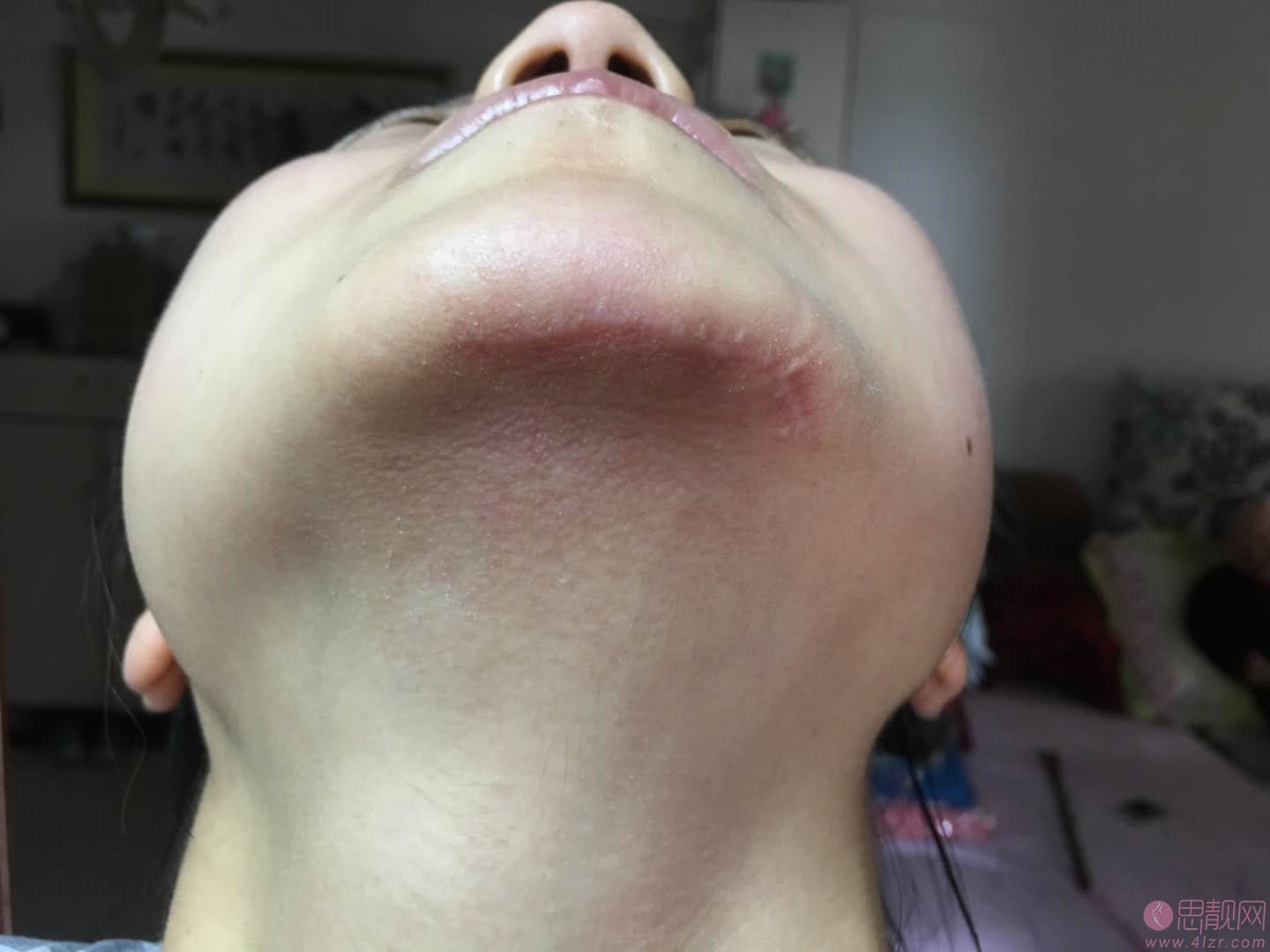 成都八大处医疗美容医院吴冬梅祛疤怎么样？附祛疤术后真人案例分享及2020价格表曝光