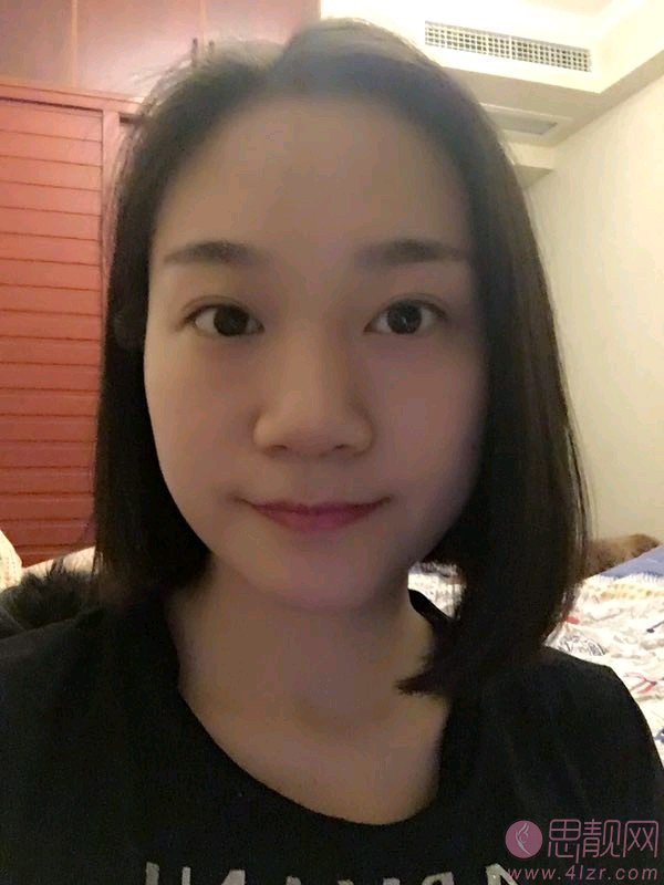 湘雅三医院整形美容外科隆鼻怎么样?附隆鼻真人案例一览及2020价格表一览
