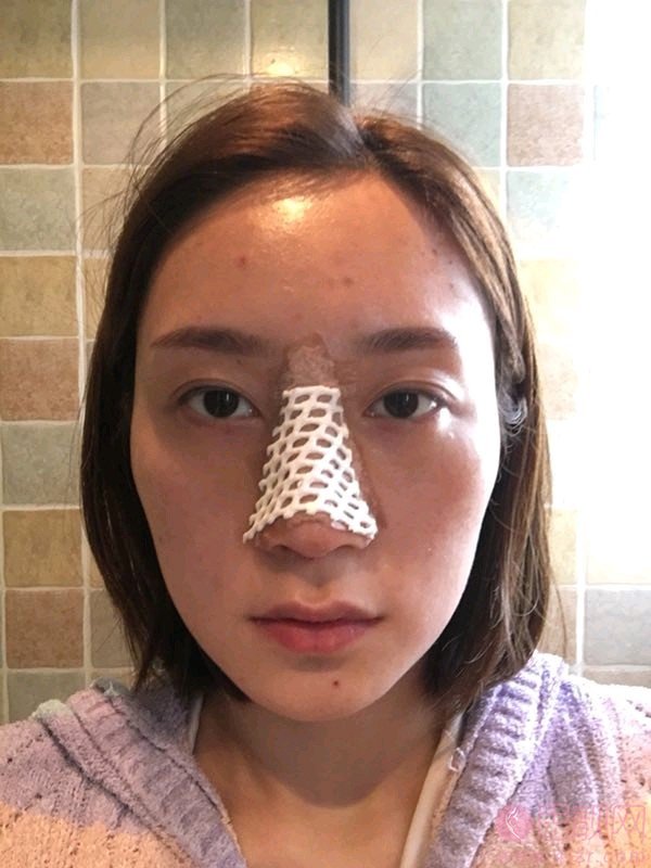 湘雅三医院整形美容外科隆鼻怎么样?附隆鼻真人案例一览及2020价格表一览