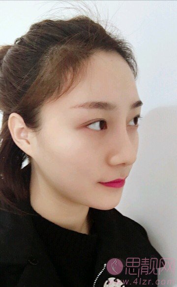 湘雅三医院整形美容外科隆鼻怎么样?附隆鼻真人案例一览及2020价格表一览
