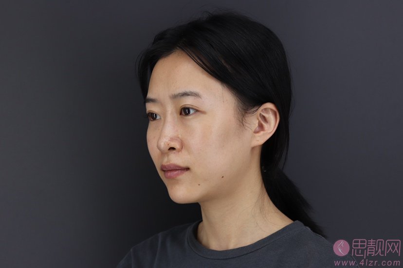 重庆郑荃丽格医疗美容激光祛眼袋好不好?2020价格表一览+祛眼袋术后案例分享