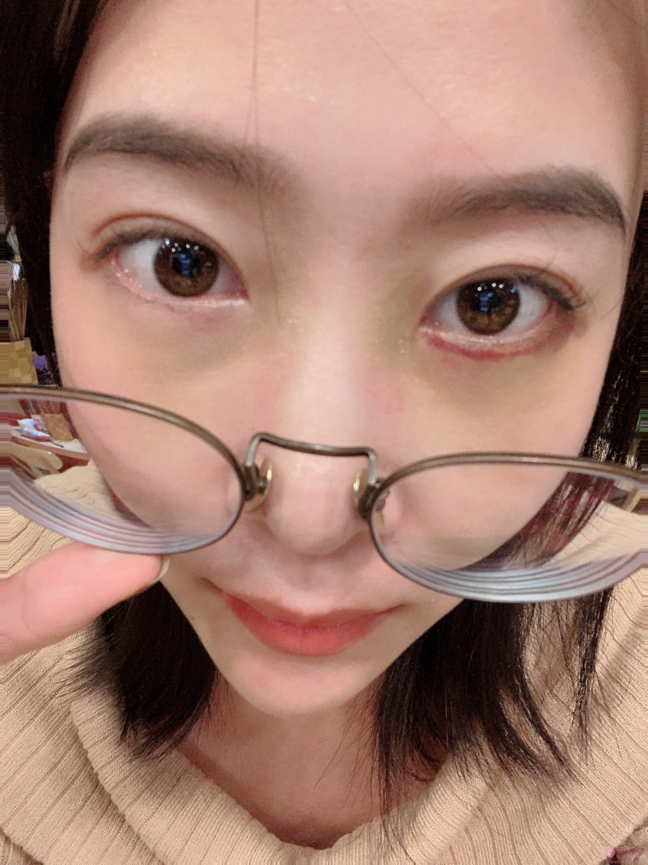重庆郑荃丽格医疗美容激光祛眼袋好不好?2020价格表一览+祛眼袋术后案例分享