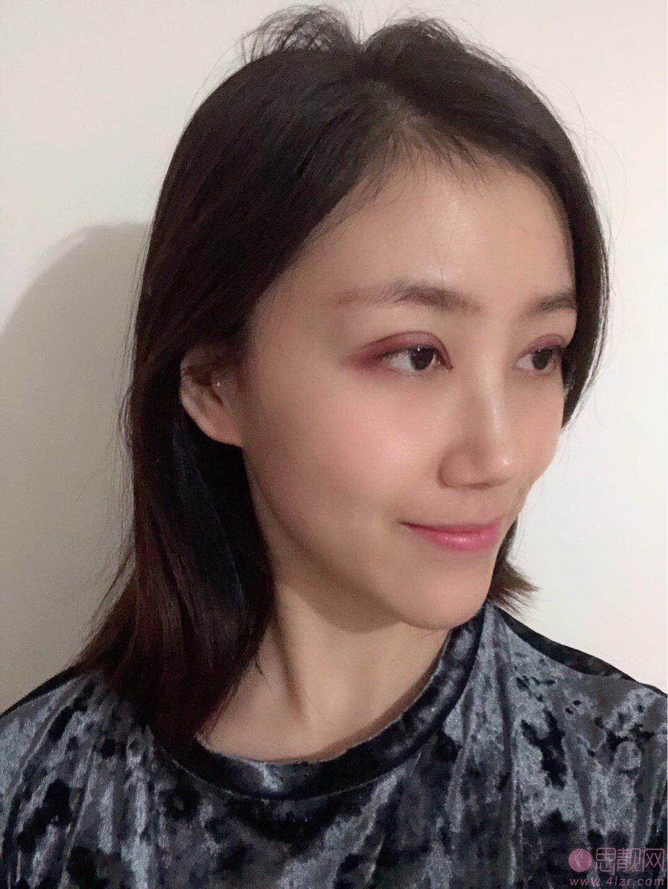 西安华旗唯美门诊部张沙沙做双眼皮手术好不好？2020价格表公布