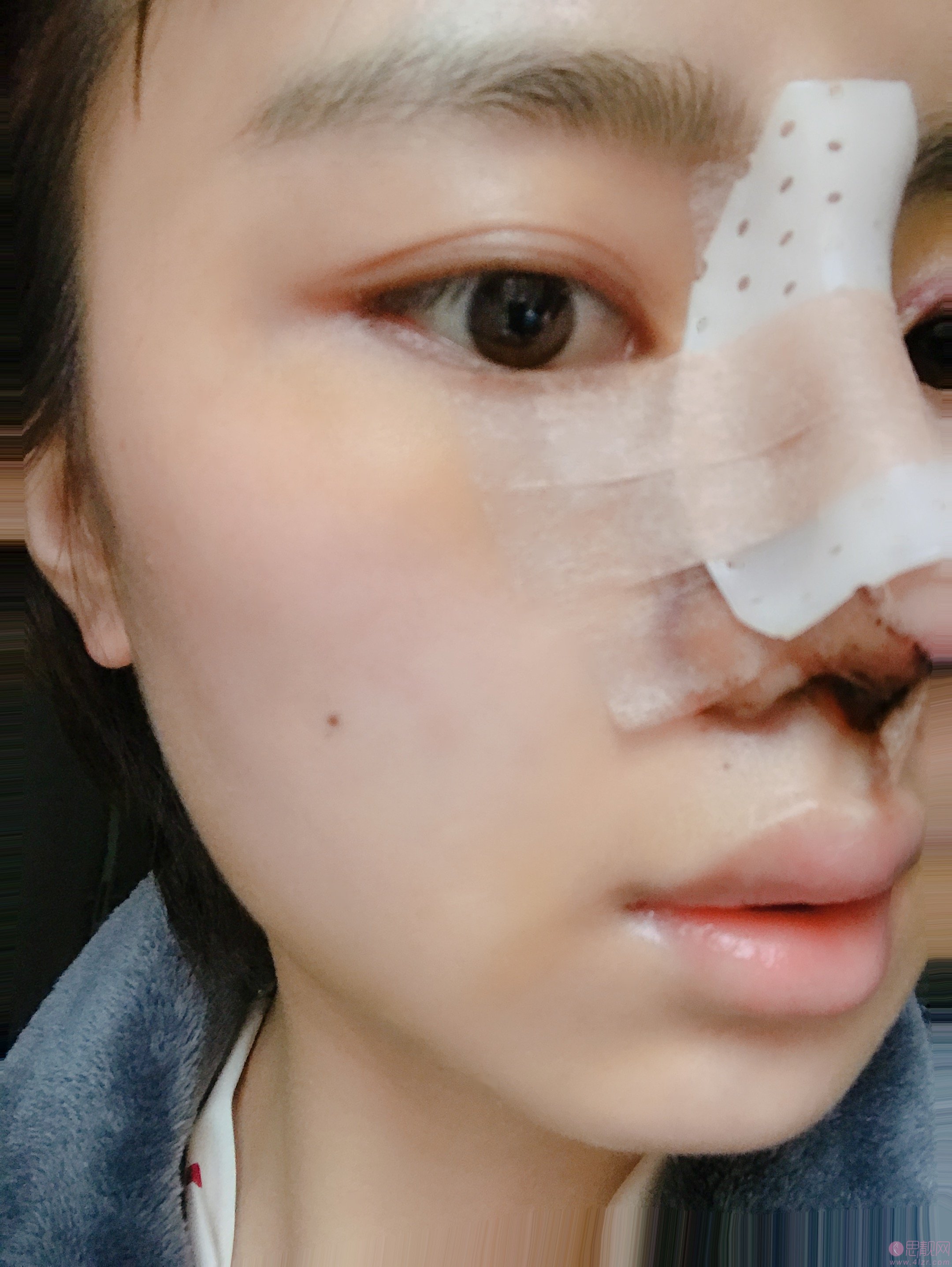 郑州元素美学整形鲁亚东隆鼻怎么样？2020价格表上线+隆鼻真人案例分享