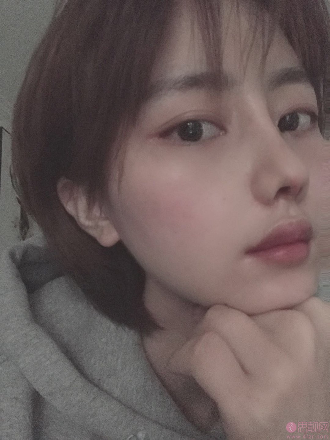 郑州元素美学整形鲁亚东隆鼻怎么样？2020价格表上线+隆鼻真人案例分享