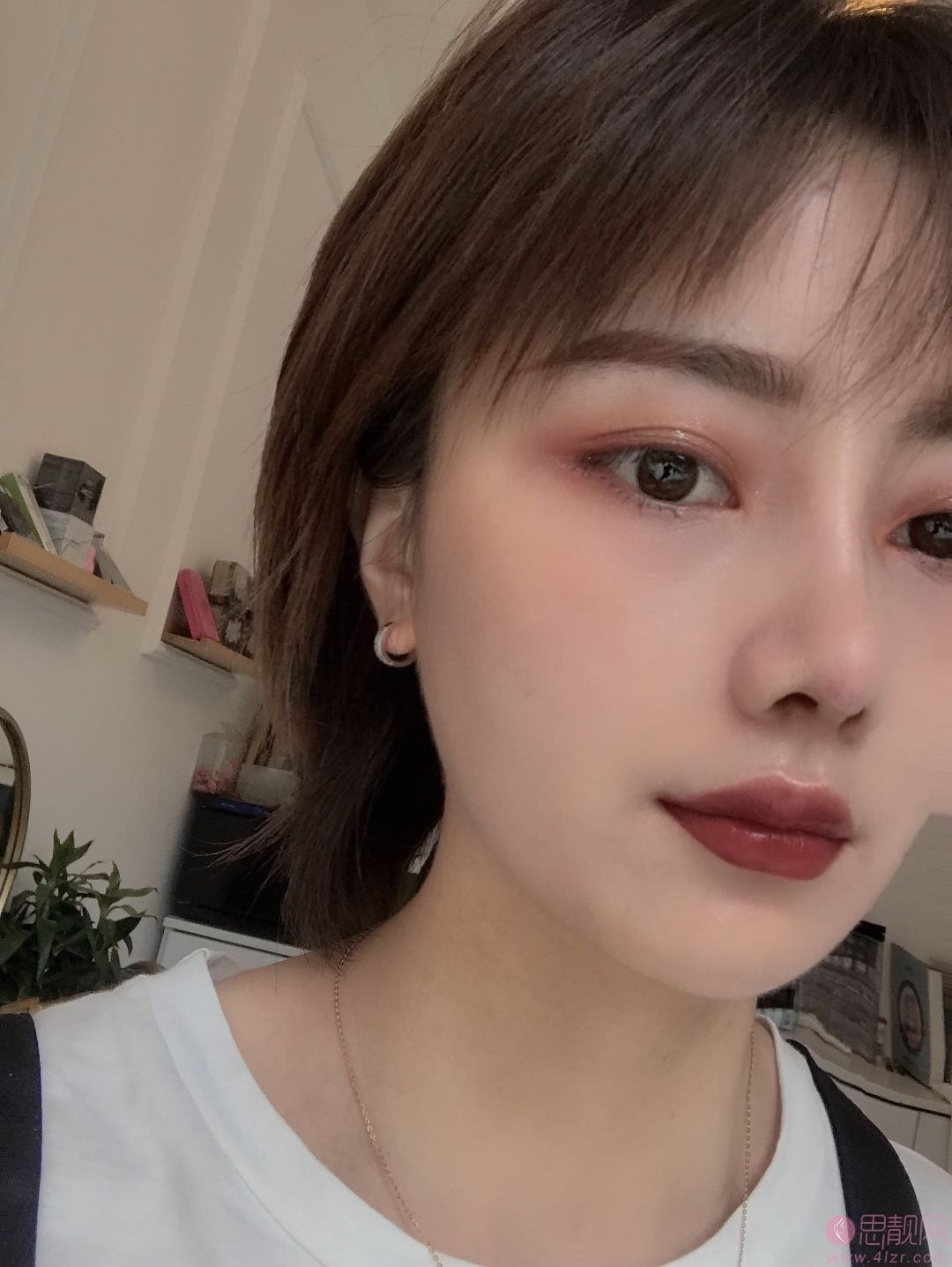 郑州元素美学整形鲁亚东隆鼻怎么样？2020价格表上线+隆鼻真人案例分享