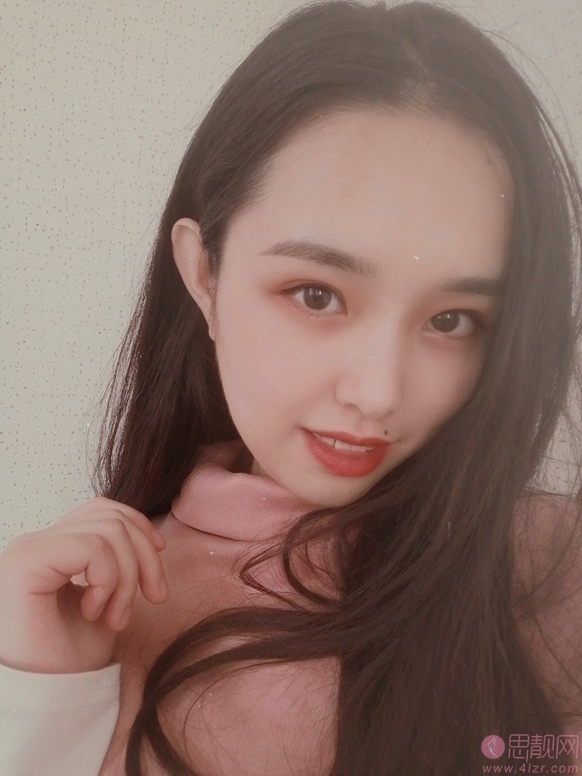 武汉蜜司医疗美容做双眼皮手术怎么样？2020价格表曝光+双眼皮术后真人案例分享