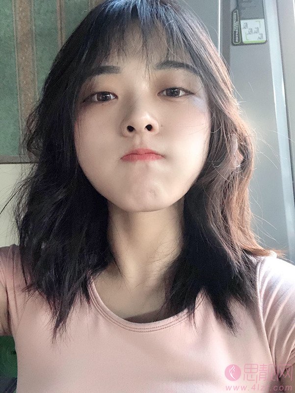 吉林国健美容医院曾蕊做双眼皮怎么样?附双眼皮术后案例一览及2020价格表发布