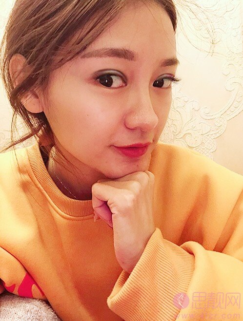 无锡爱思特整形美容医院欧阳黎平做双眼皮怎么样？2020价格表一览