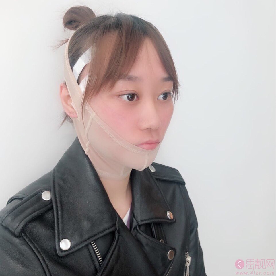 北京为尔医疗美容诊所梁振兴做埋线提升效果怎么样？附提升案例一览及2020价格表公布
