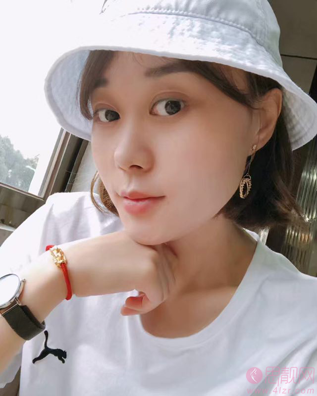 北京为尔医疗美容诊所梁振兴做埋线提升效果怎么样？附提升案例一览及2020价格表公布