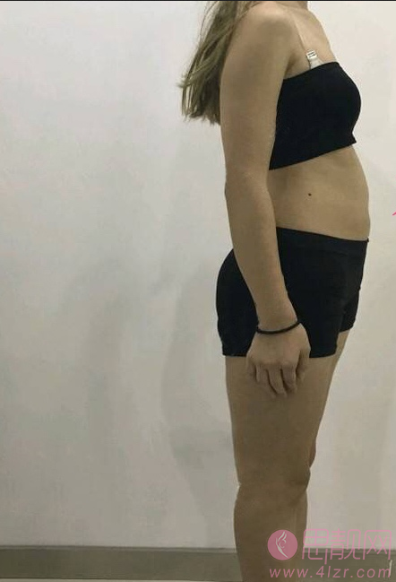 杭州西芷医疗美容吸脂怎么样?2020价格表发布+吸脂术后真人案例一览