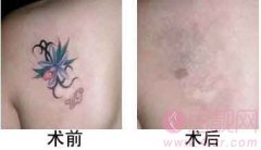 激光洗纹身后会出现留疤吗？