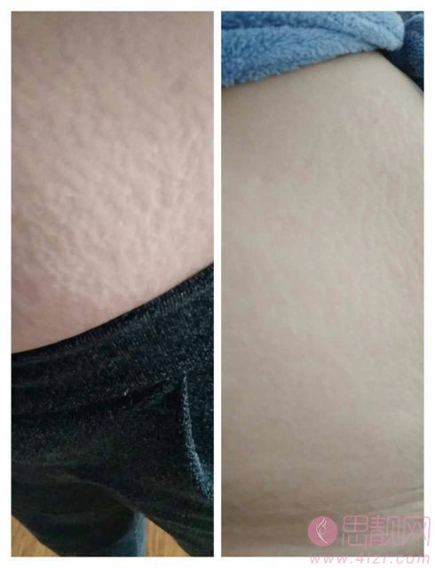 激光可以消除妊娠纹吗？