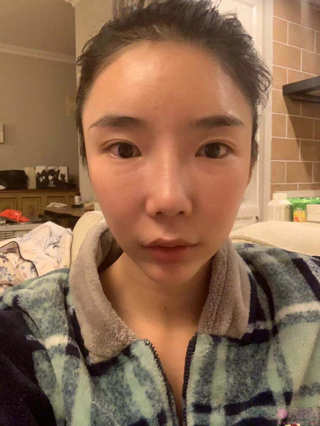 北京东方百合医疗美容门诊部王世勇做双眼皮修复怎么样？2020价格表出炉