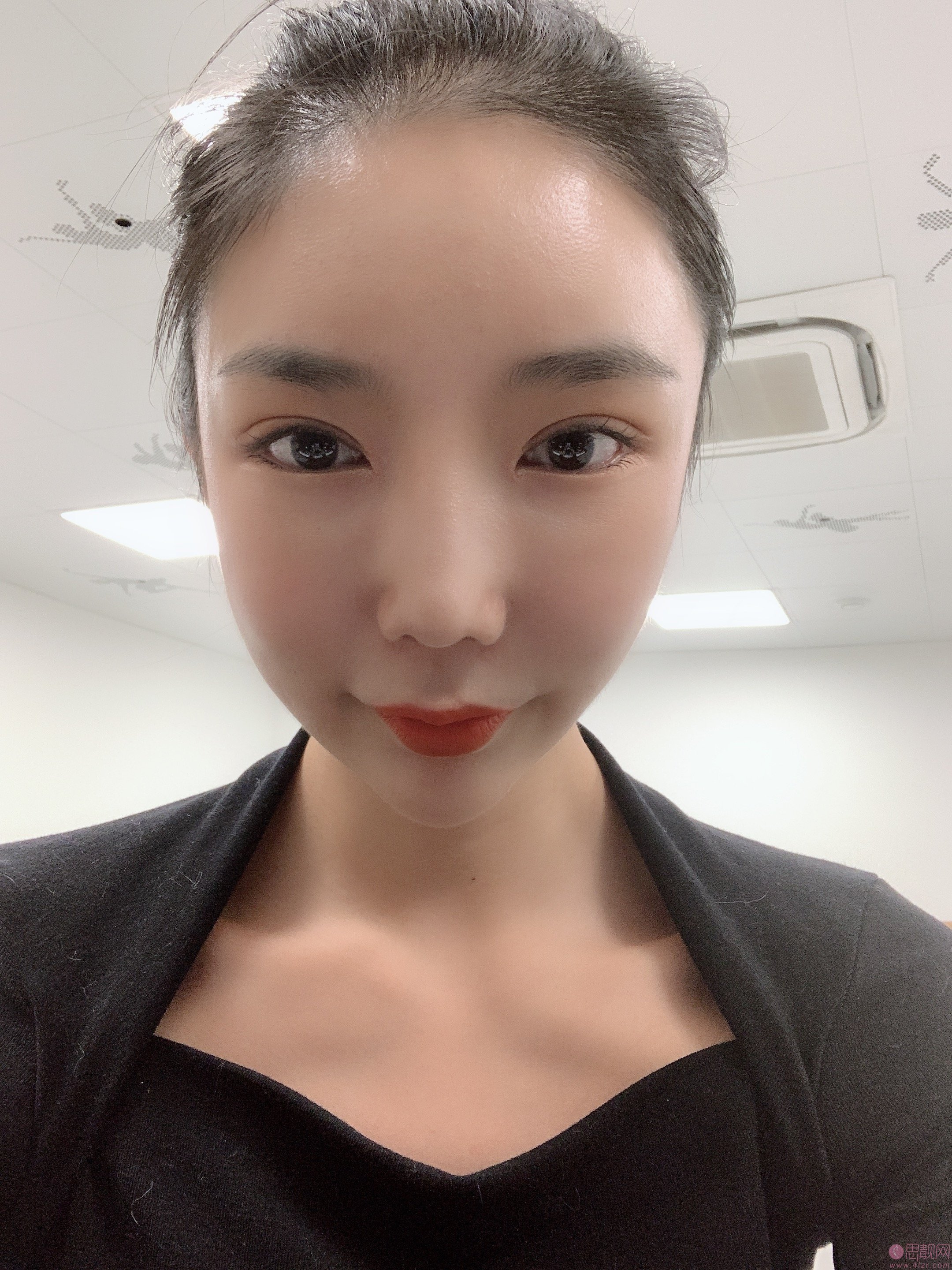 北京东方百合医疗美容门诊部王世勇做双眼皮修复怎么样？2020价格表出炉