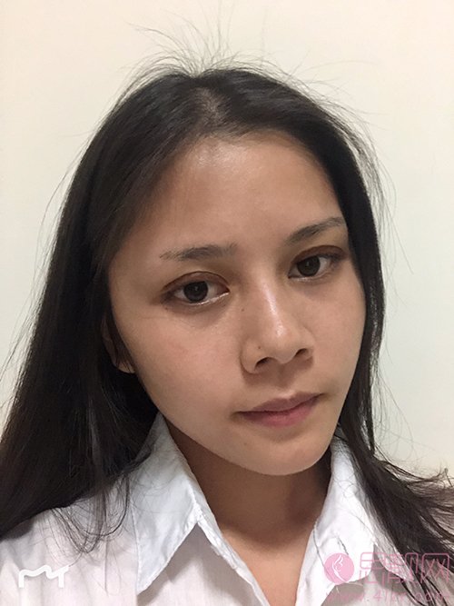 苏州爱思特美容医院做双眼皮手术好不好?2020价格表曝光+双眼皮术后真人案例分享