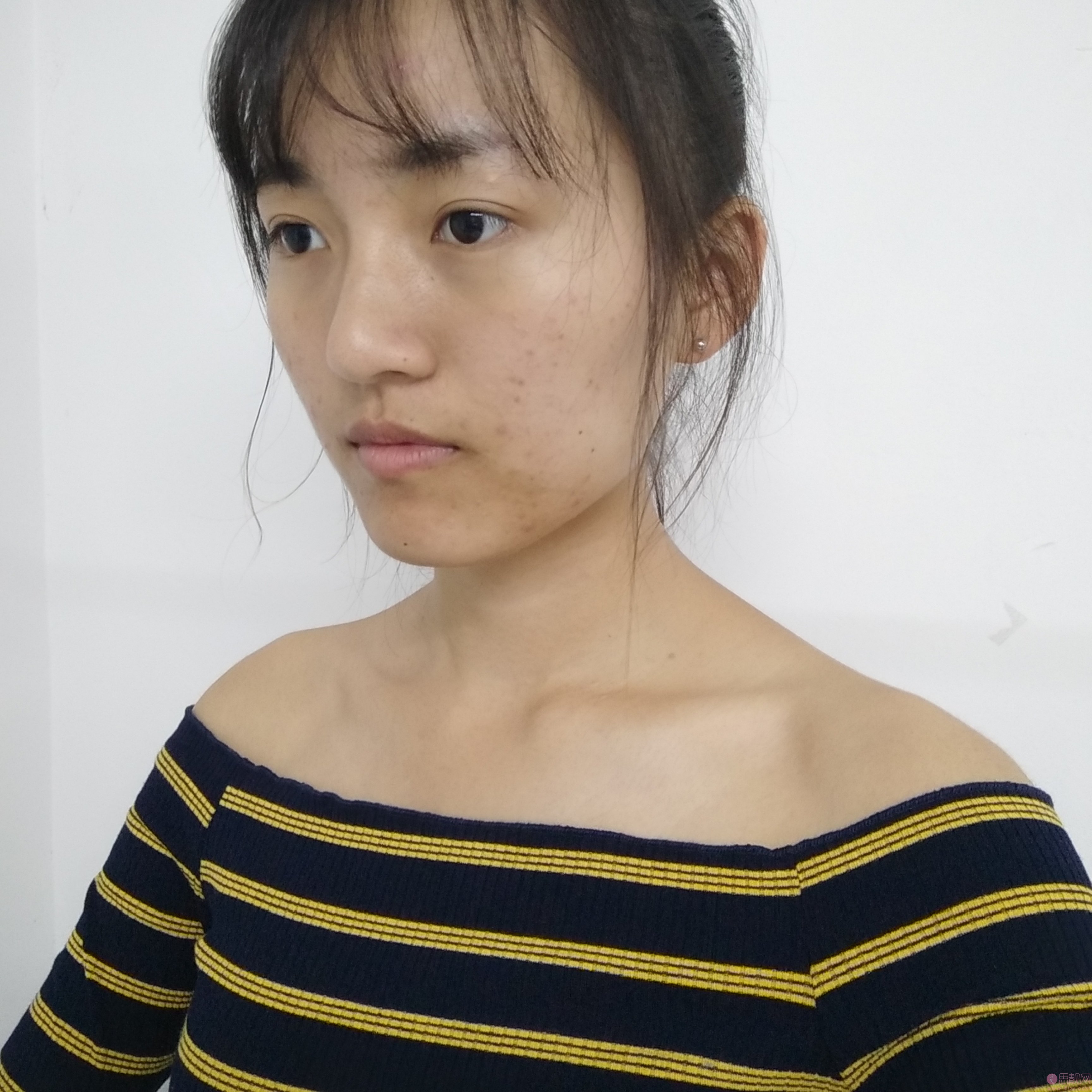 眉山悦美医疗美容门诊部祛痘怎么样？2020价格表曝光+祛痘真人案例分享