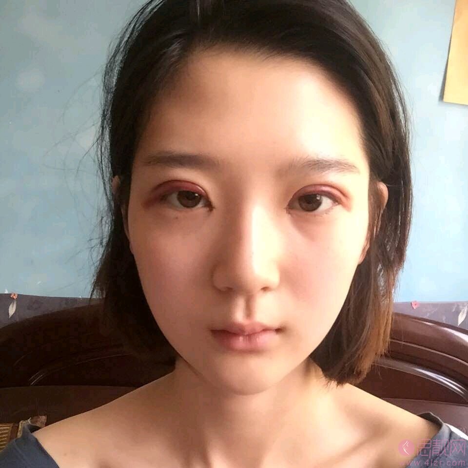 青岛博士医学美容2020价格表公布+双眼皮术后真人案例分享