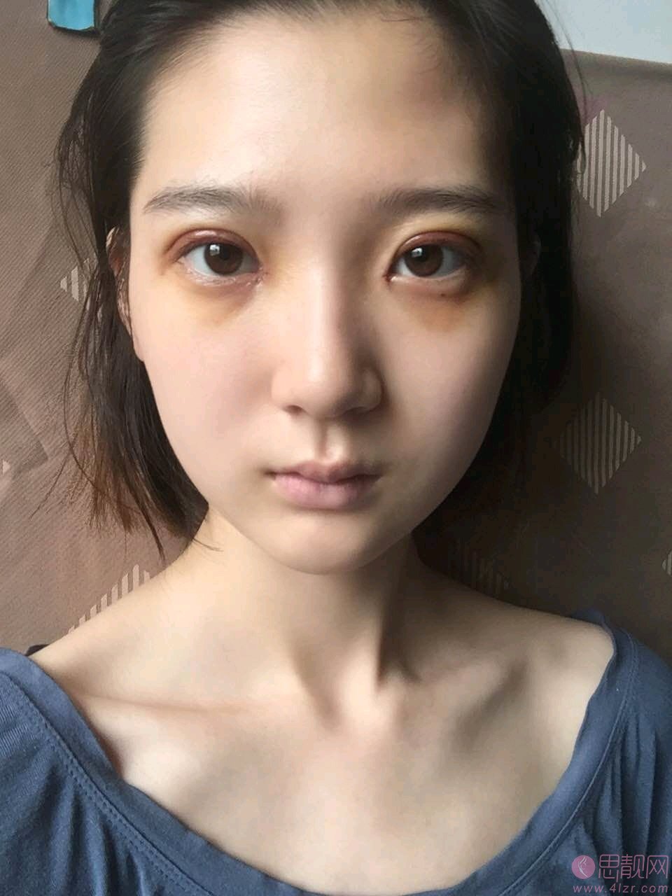 青岛博士医学美容2020价格表公布+双眼皮术后真人案例分享