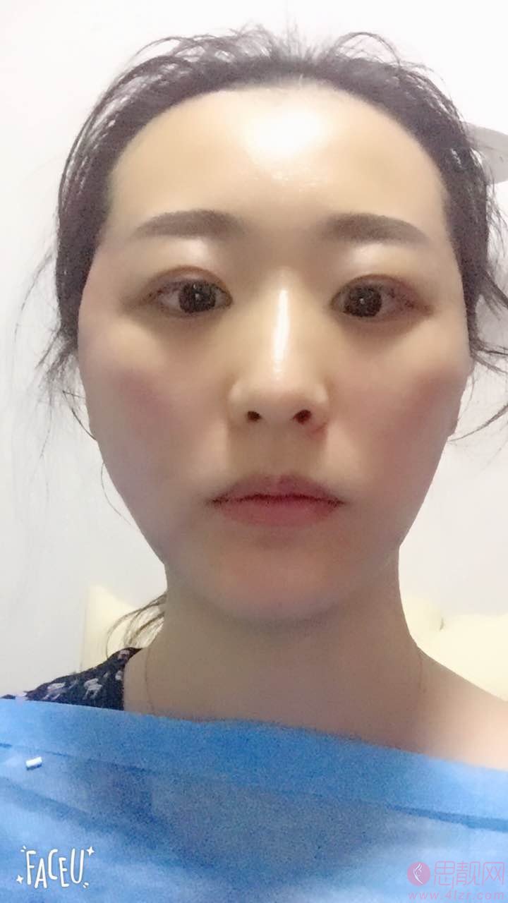 青岛庞东剑医疗美容庞东剑做埋线提升怎么样？2020价格表一览