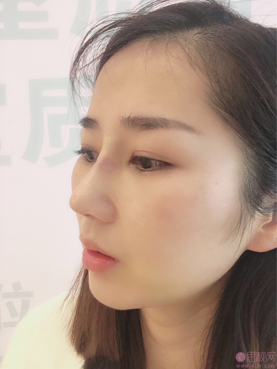 武汉同济医院整形隆鼻价格?附2020价格表曝光+隆鼻真人案例分享