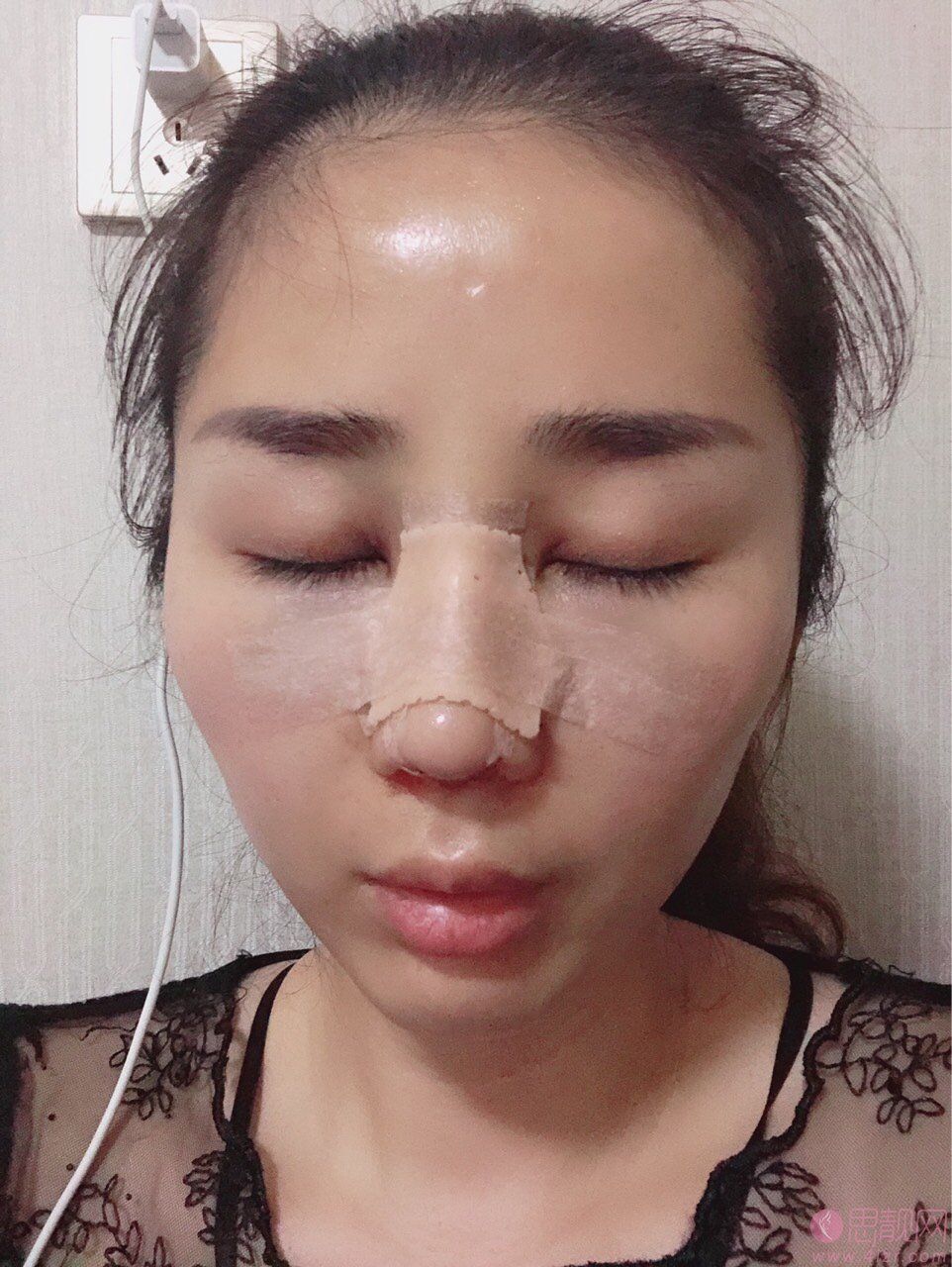 武汉同济医院整形隆鼻价格?附2020价格表曝光+隆鼻真人案例分享
