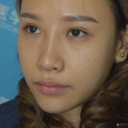 武汉同济医院整形隆鼻好不好？附隆鼻真人案例一览及2020价格表曝光
