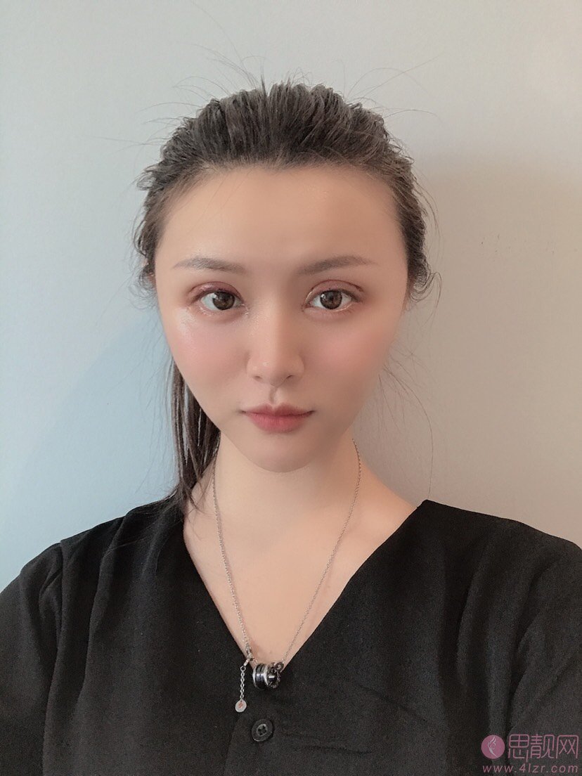 成都欧诺森医疗美容(整形外科)徐楠做双眼皮怎么样?2020价格表发布