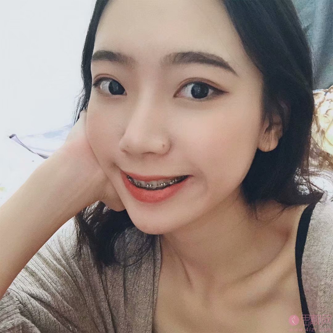 成都舒雅口腔矫正牙齿好不好?附矫正案例一览