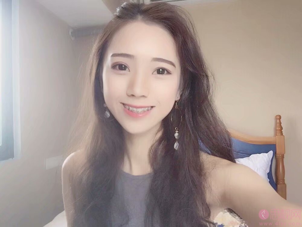 成都舒雅口腔矫正牙齿好不好?附矫正案例一览