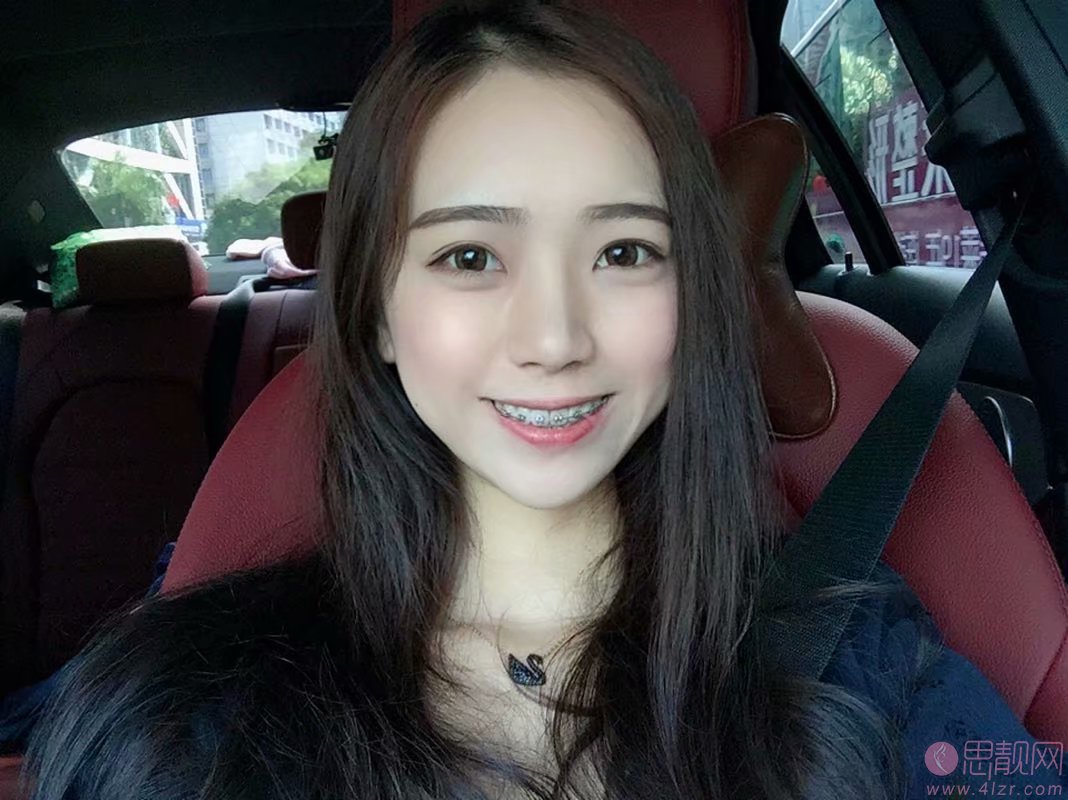 成都舒雅口腔矫正牙齿好不好?附矫正案例一览