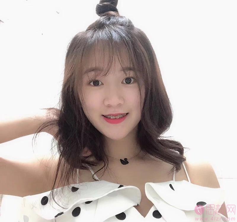 无锡坤如玛丽整形美容医院2020价格表曝光+双眼皮真人案例分享