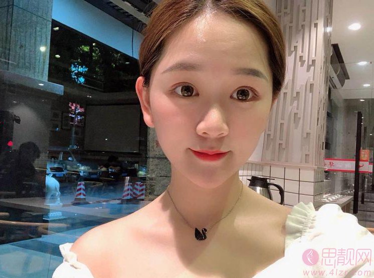 无锡坤如玛丽整形美容医院2020价格表曝光+双眼皮真人案例分享