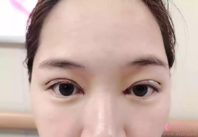 无锡坤如玛丽整形美容医院2020价格表曝光+双眼皮真人案例分享