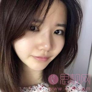 武汉媄妲医疗美容郑竞帆隆鼻如何？2020价格表曝光+隆鼻真人案例一览