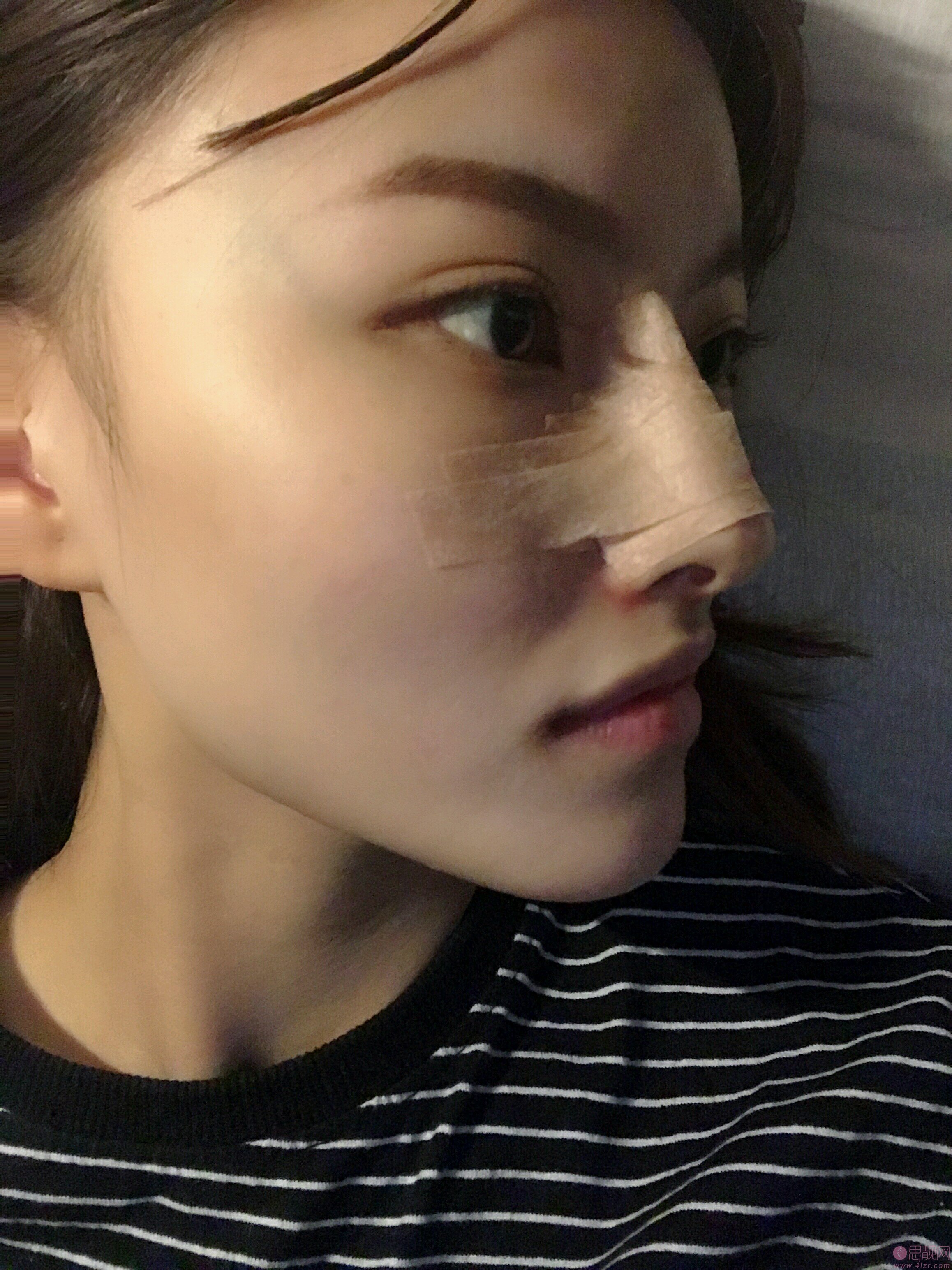 西安赫比医疗美容门诊部2020价格表公开+手术缩鼻翼案例一览
