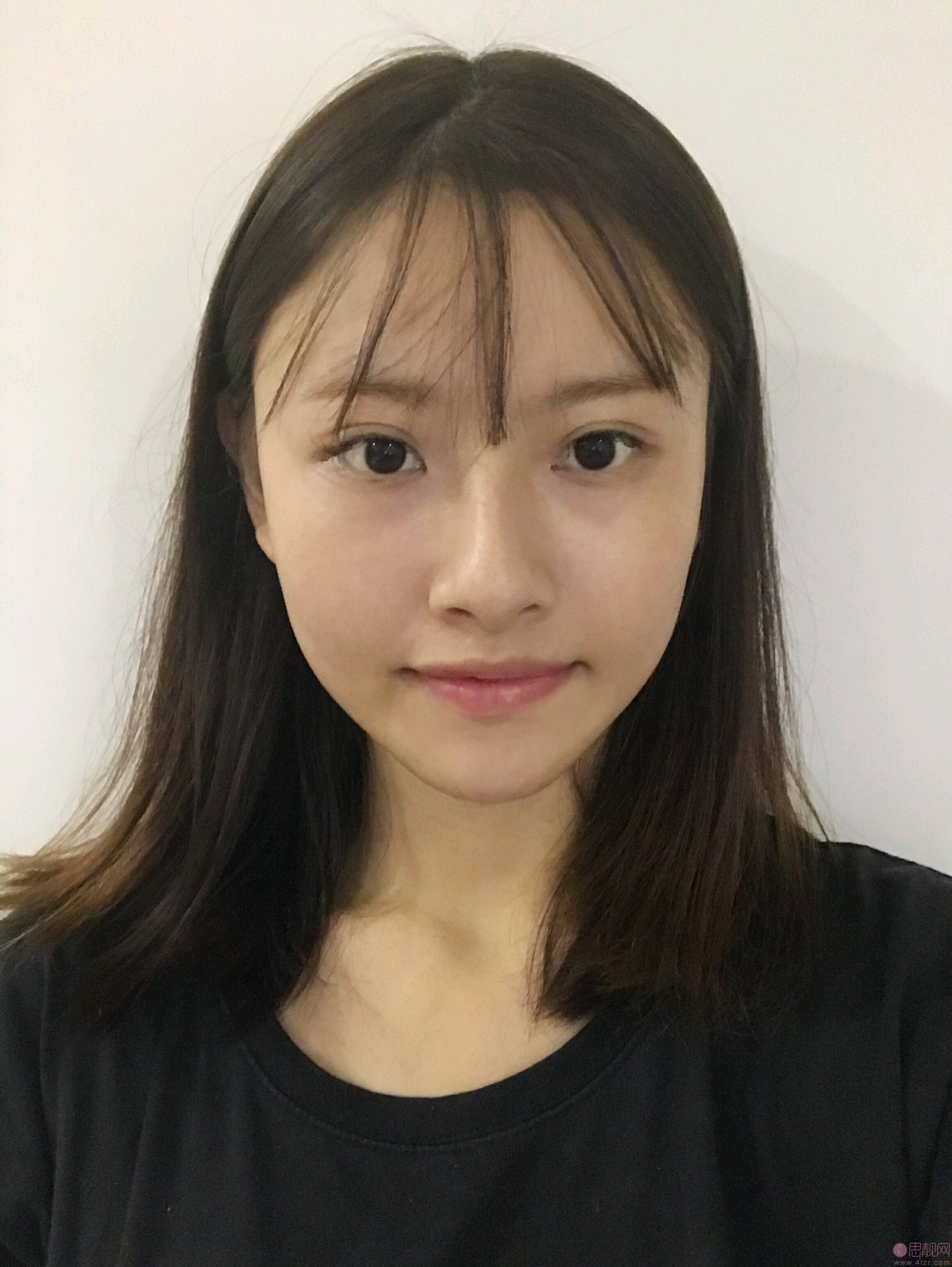 西安赫比医疗美容门诊部2020价格表公开+手术缩鼻翼案例一览