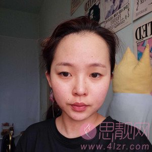 山东省立医院整形美容科霍然做双眼皮怎么样?附双眼皮案例及2020价格表曝光