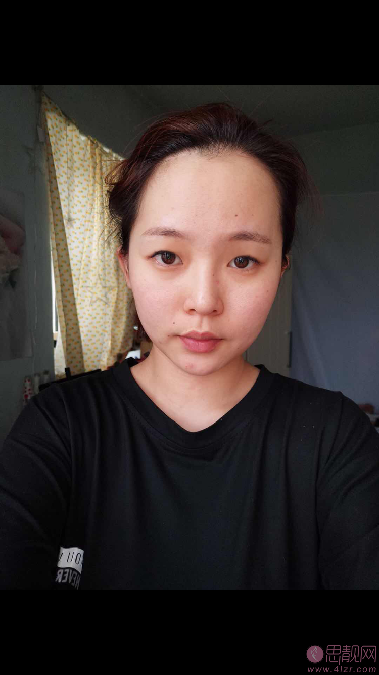 山东省立医院整形美容科霍然做双眼皮怎么样?附双眼皮案例及2020价格表曝光